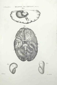 Antique Brain Diseases - Lithograph By Ottavio Muzzi - 1843