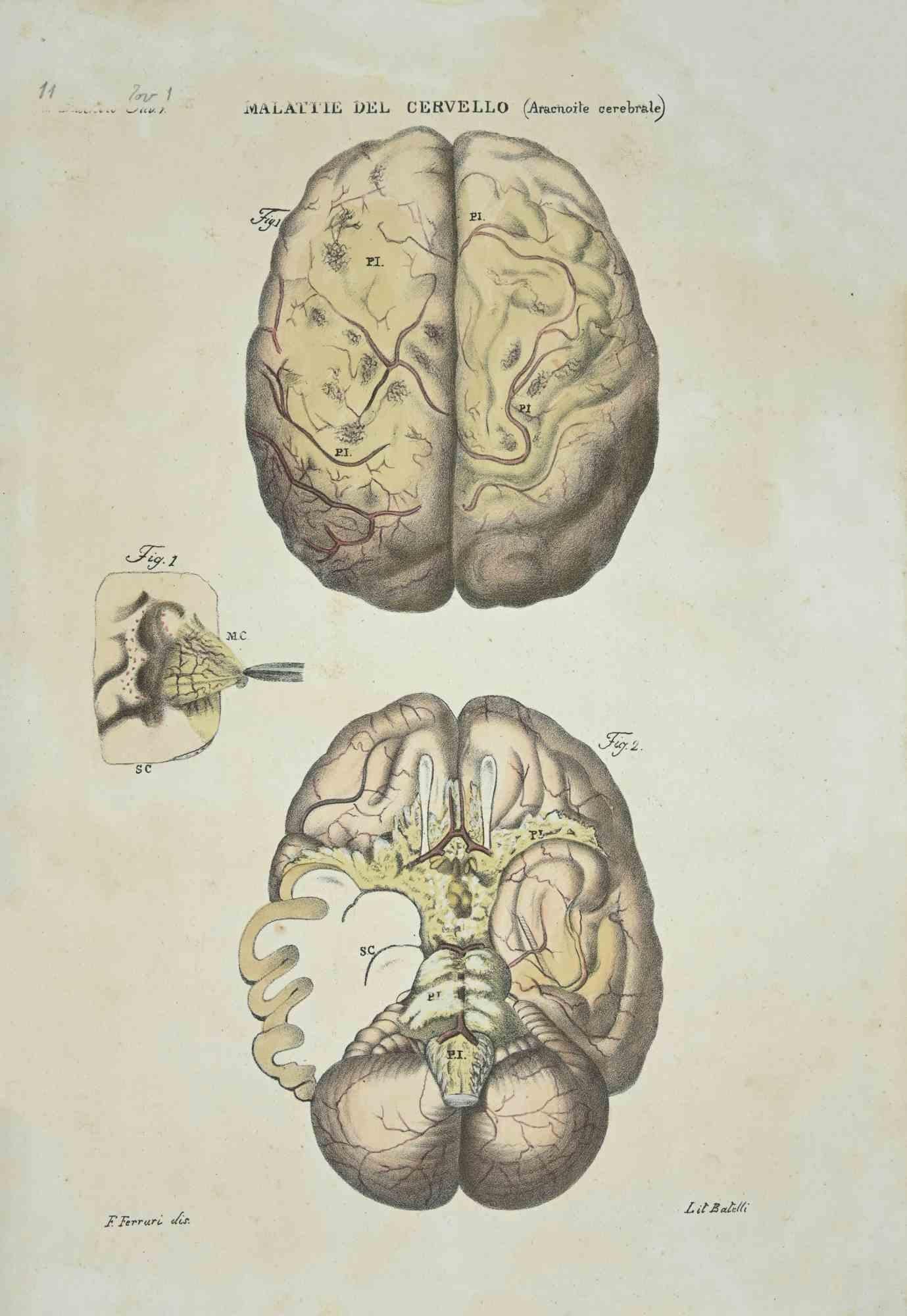 Brain Diseases is a lithograph hand colored by Ottavio Muzzi for the edition of Antoine Chazal, Human Anatomy, Printers Batelli and Ridolfi, 1843.

The work belongs to the Atlante generale della anatomia patologica del corpo umano by Jean