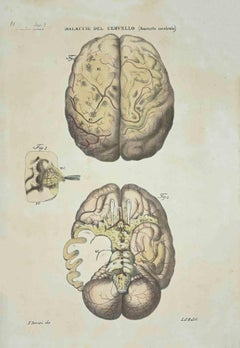 Antique Brain Diseases - Lithograph By Ottavio Muzzi - 1843