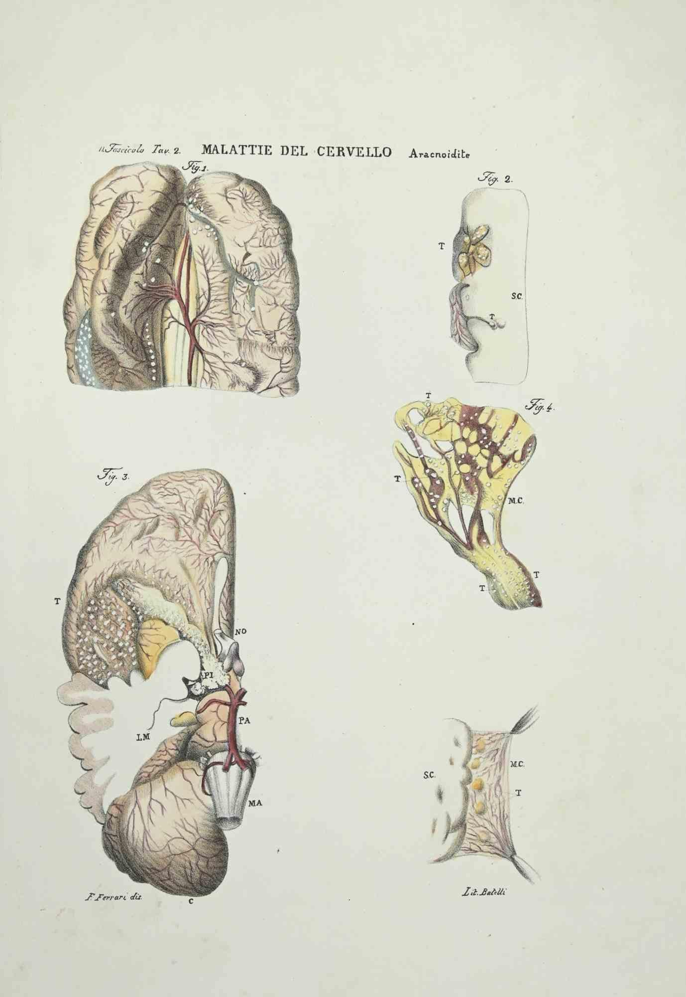 Brain Diseases is a lithograph hand colored by Ottavio Muzzi for the edition of Antoine Chazal, Human Anatomy, Printers Batelli and Ridolfi, 1843.

The work belongs to the Atlante generale della anatomia patologica del corpo umano by Jean