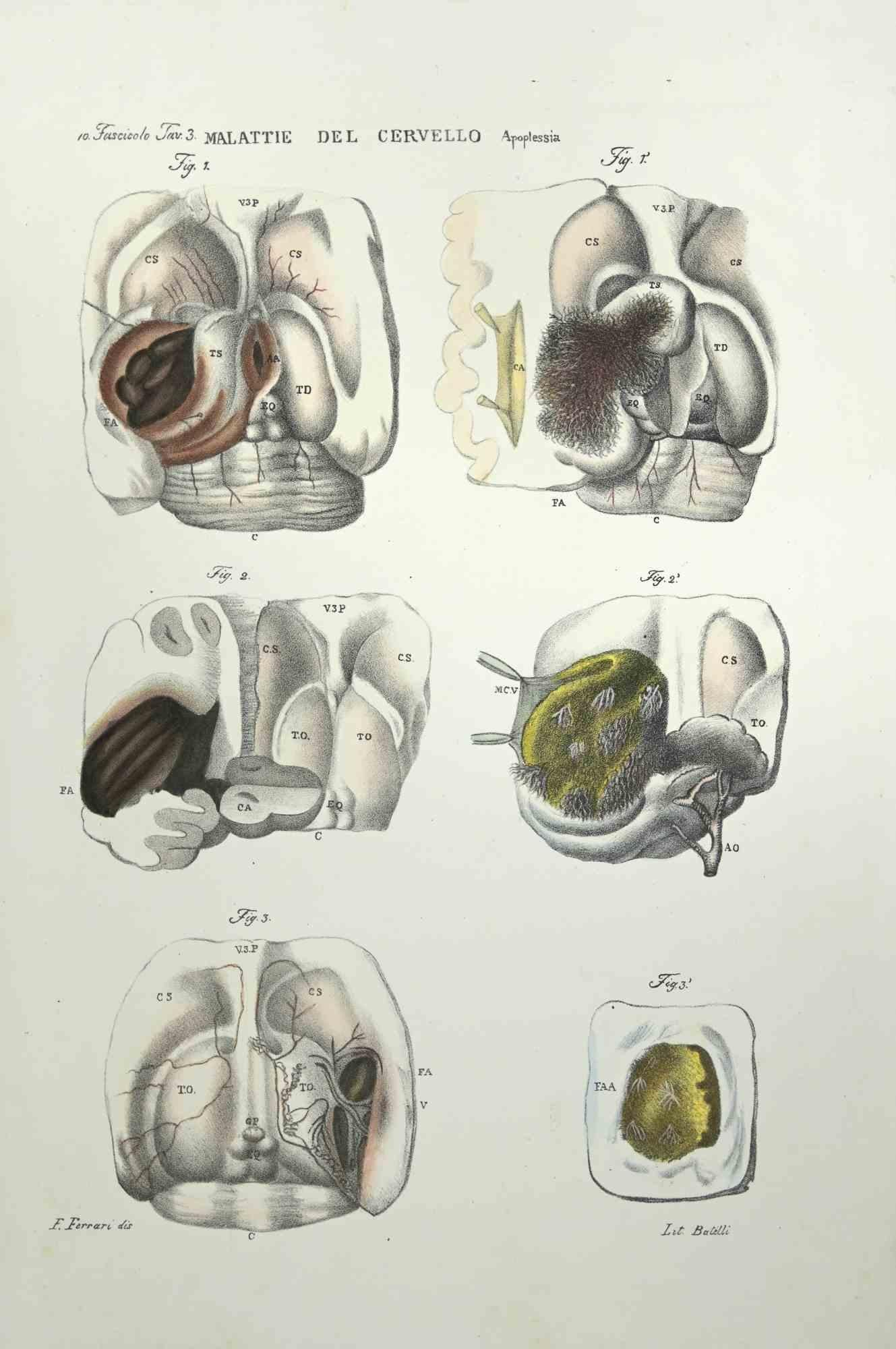 Brain Diseases is a lithograph hand colored by Ottavio Muzzi for the edition of Antoine Chazal, Human Anatomy, Printers Batelli and Ridolfi, 1843.

The work belongs to the Atlante generale della anatomia patologica del corpo umano by Jean