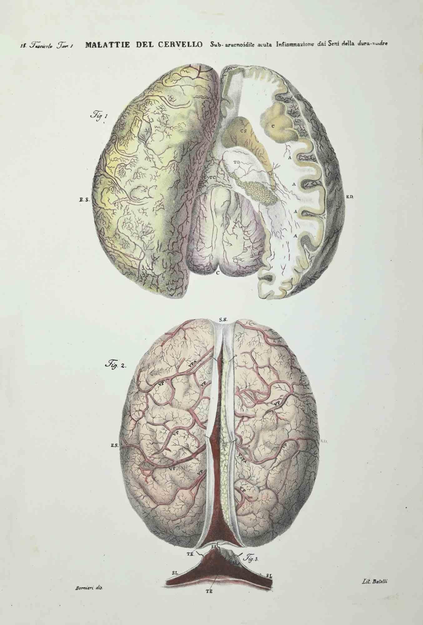 Brain Diseases is a lithograph hand colored by Ottavio Muzzi for the edition of Antoine Chazal, Human Anatomy, Printers Batelli and Ridolfi, realized in 1843.

Signed on plate on the left corner.

The artwork belongs to the "Atlante Generale della