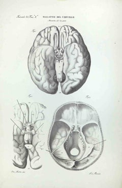  Brain Diseases  - Lithograph By Ottavio Muzzi - 1843