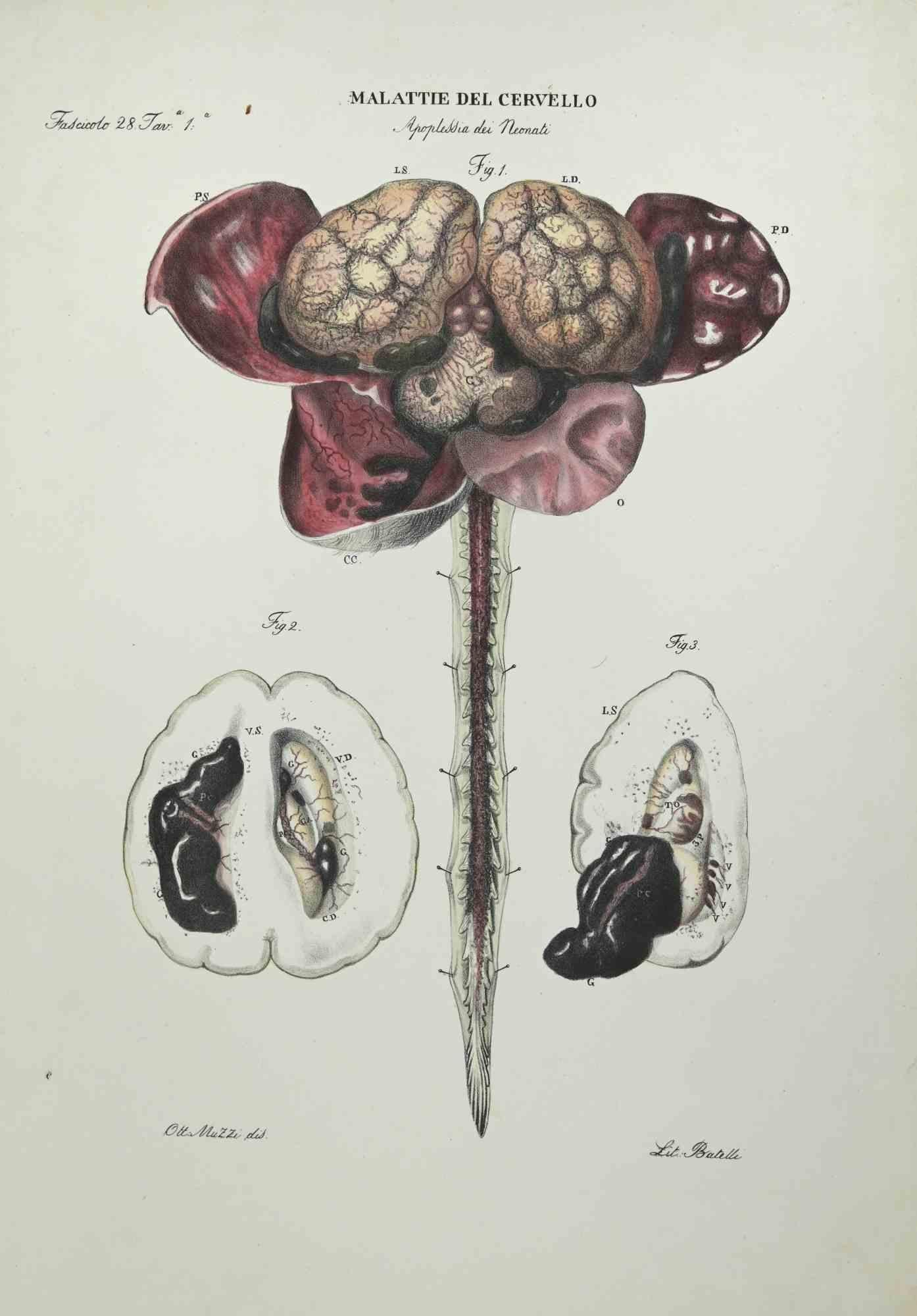  Brain Diseases is a lithograph hand colored by Ottavio Muzzi for the edition of Antoine Chazal,Human Anatomy, Printers Batelli and Ridolfi, realized in 1843.
Signed on plate on the lower left margin. 

The artwork belongs to the "Atlante Generale