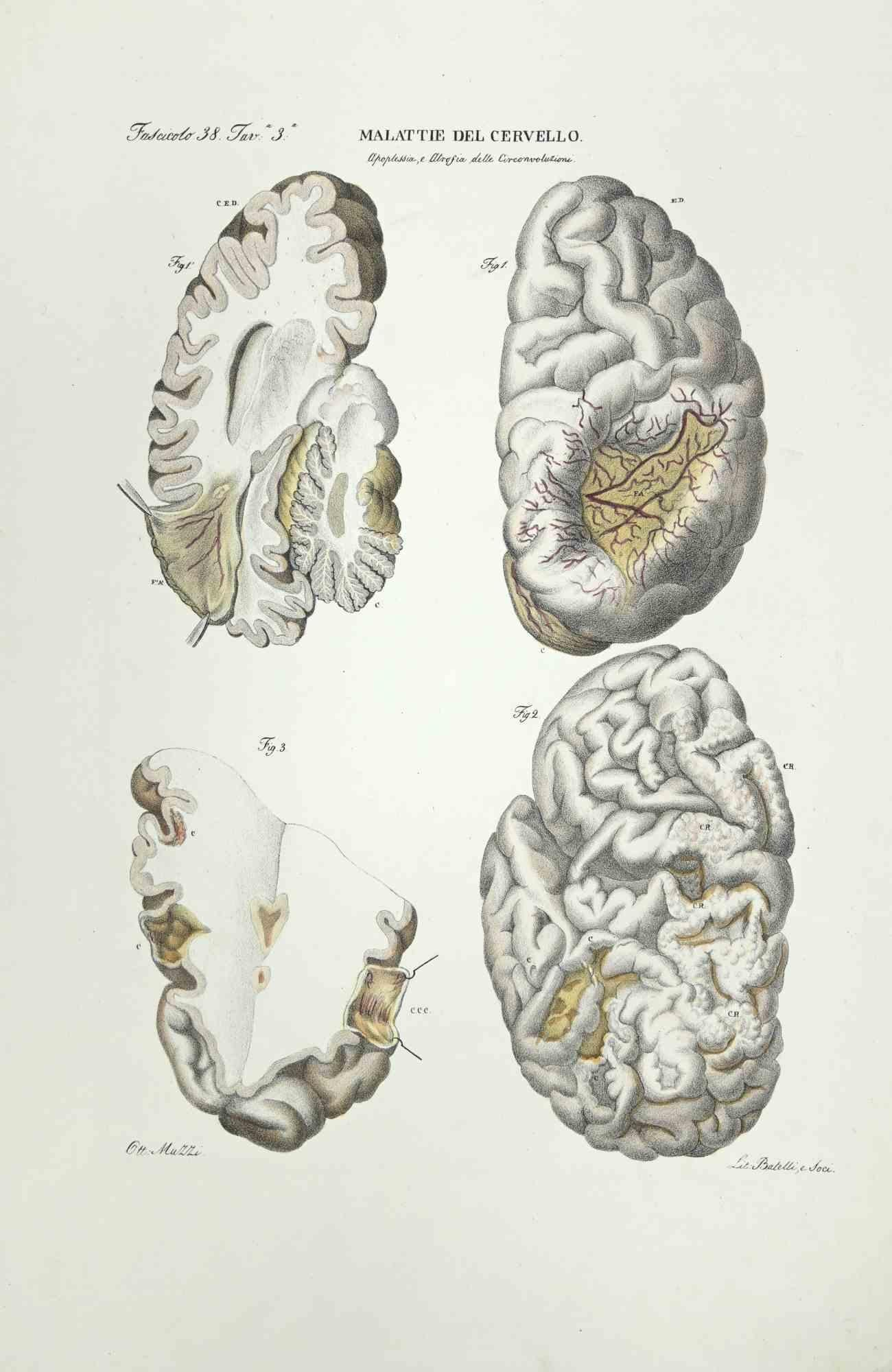 Brain Diseases ist eine handkolorierte Lithographie von Ottavio Muzzi für die Ausgabe von Antoine Chazal, Human Anatomy, Printers Batelli and Ridolfi, aus dem Jahr 1843.

Signiert auf der Platte am unteren linken Rand.

Das Kunstwerk gehört zum