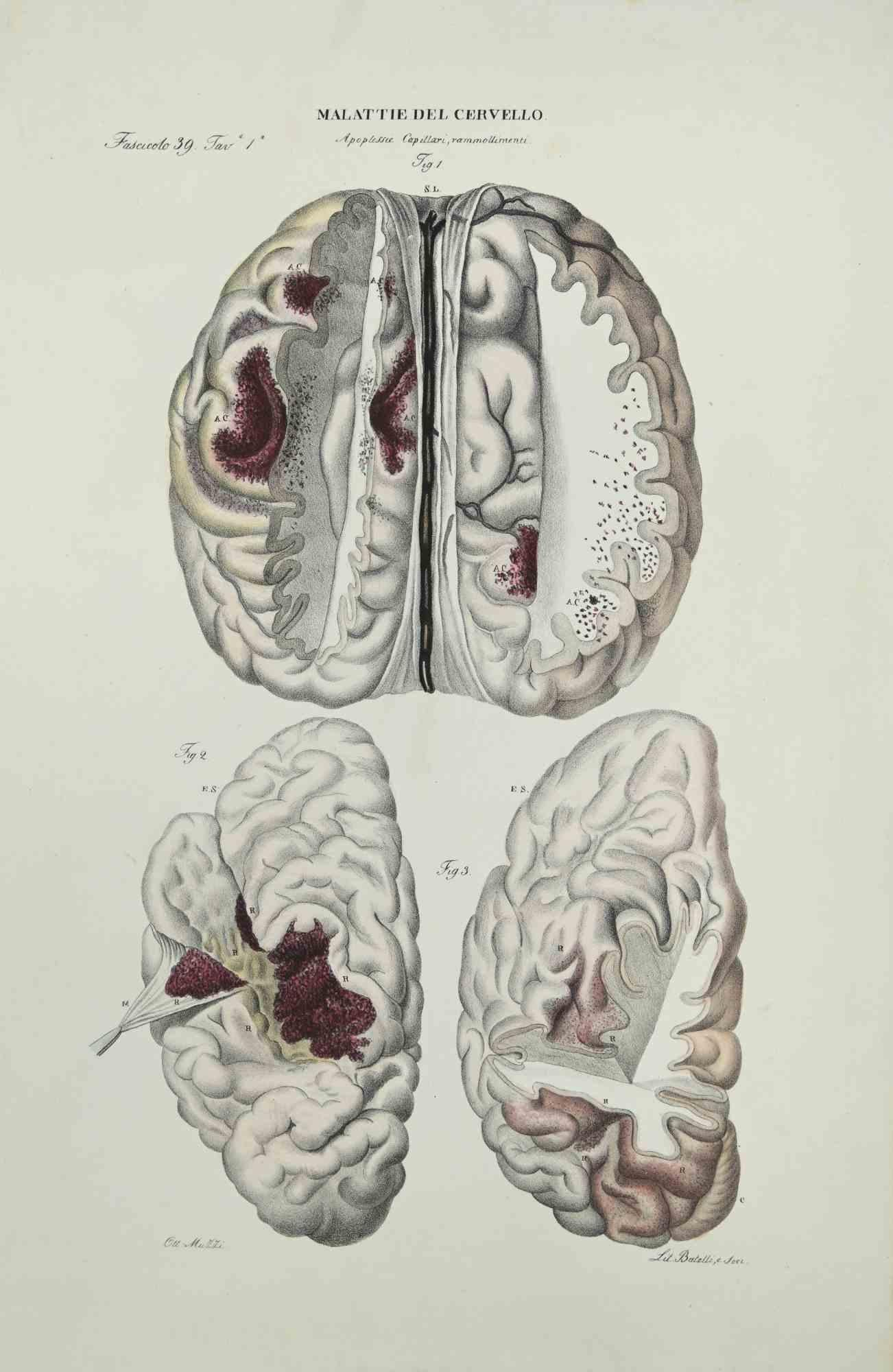 Brain Diseases ist eine handkolorierte Lithographie von Ottavio Muzzi für die Ausgabe von Antoine Chazal, Human Anatomy, Printers Batelli and Ridolfi, aus dem Jahr 1843.

Signiert auf der Platte am unteren linken Rand.

Das Kunstwerk gehört zum