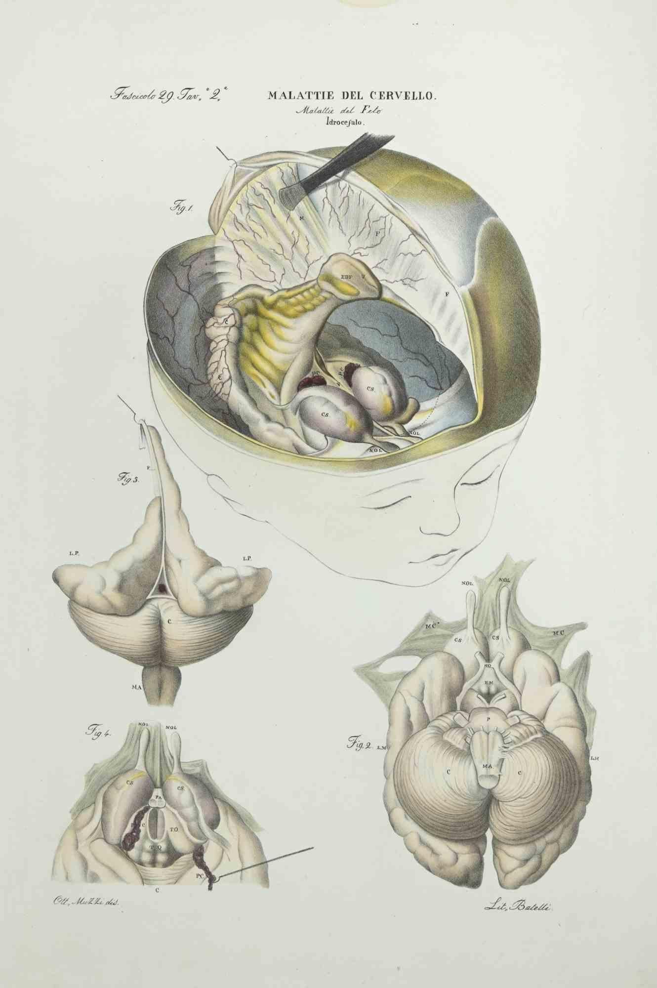 Brain Diseases is a lithograph hand colored by Ottavio Muzzi for the edition of Antoine Chazal,Human Anatomy, Printers Batelli and Ridolfi, realized in 1843.

Signed on plate on the lower left margin.

The artwork belongs to the "Atlante Generale