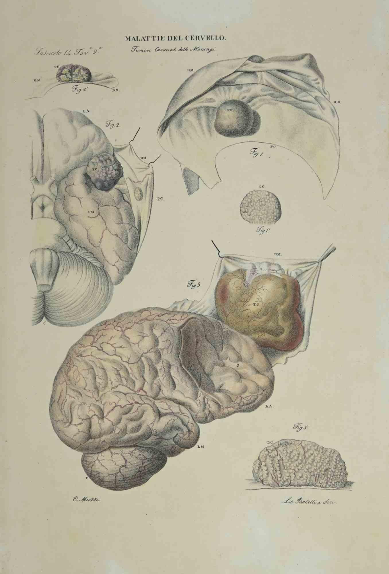 Brain Diseases is a lithograph hand colored by Ottavio Muzzi for the edition of Antoine Chazal,Human Anatomy, Printers Batelli and Ridolfi, realized in 1843.
Signed on plate on the lower left margin. 

The artwork belongs to the "Atlante Generale
