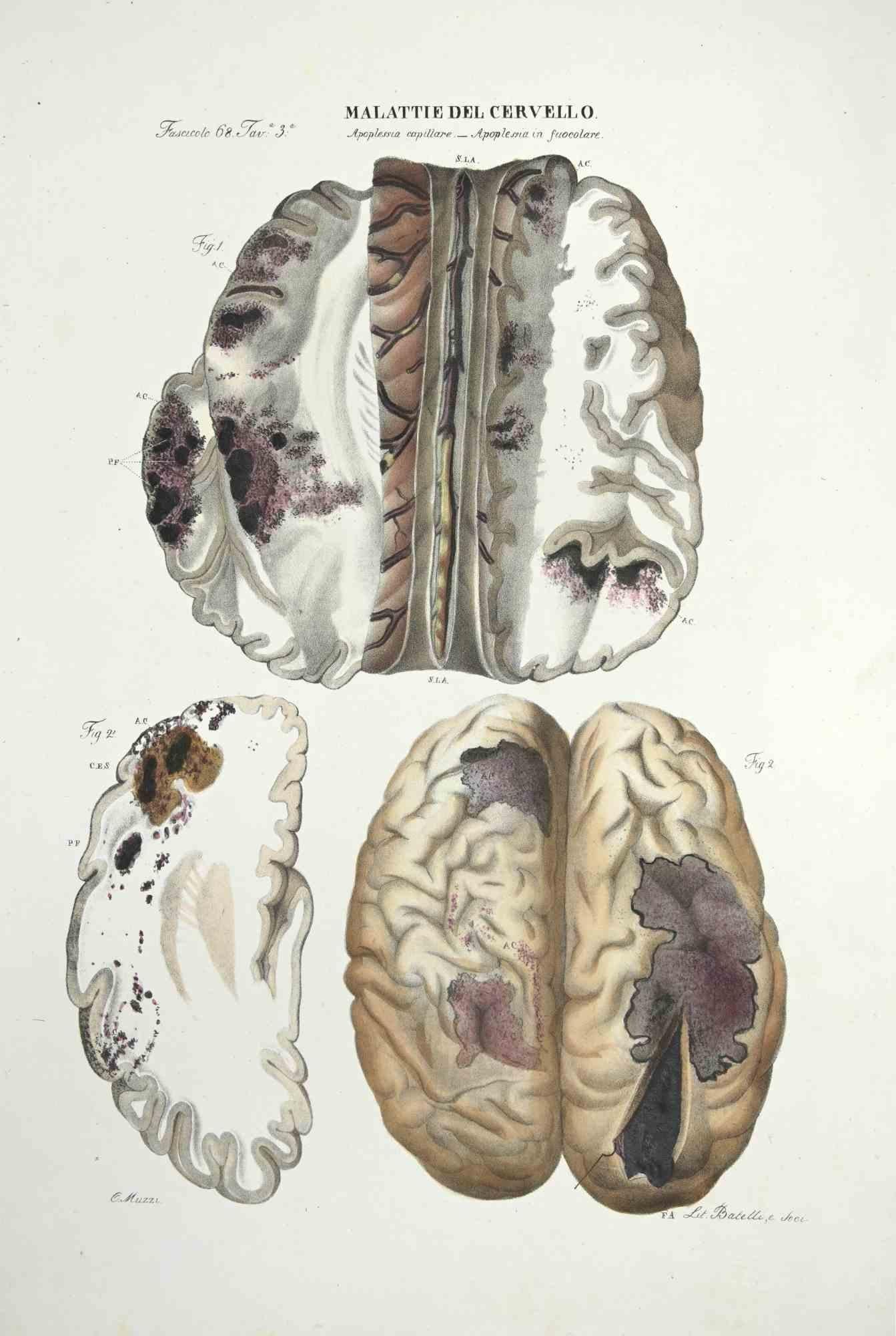 Brain Diseases  is a lithograph hand colored by Ottavio Muzzi for the edition of Antoine Chazal,Human Anatomy, Printers Batelli and Ridolfi, realized in 1843.

Signed on plate on the lower left margin.

The artwork belongs to the "Atlante Generale