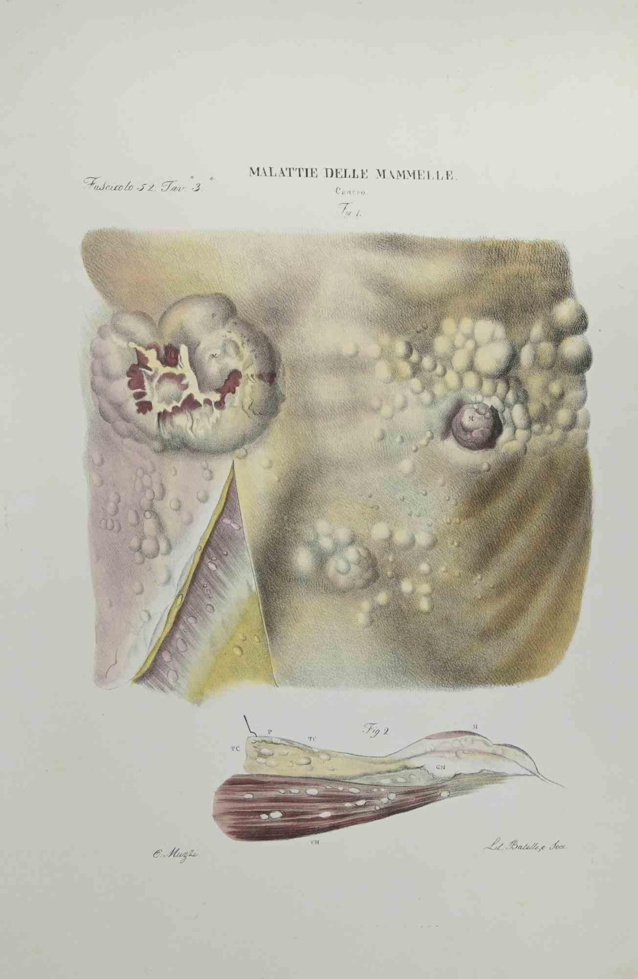 Breast disease – Lithographie von Ottavio Muzzi – 1843