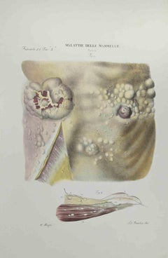Malattia del seno - Litografia di Ottavio Muzzi - 1843