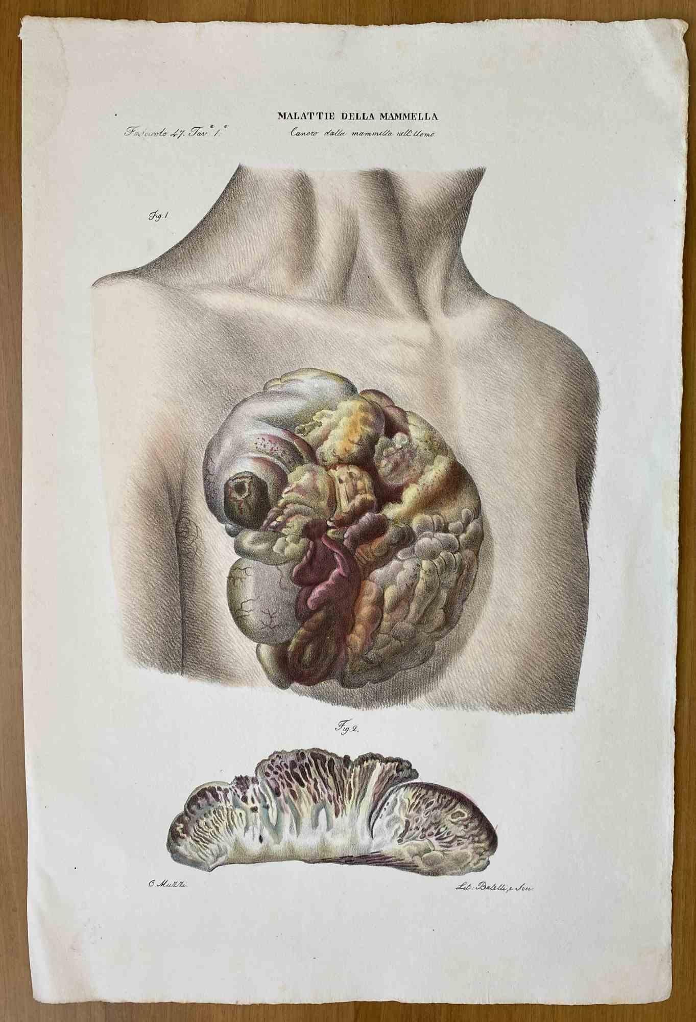Enfermedades de la mama es una litografía coloreada a mano por Ottavio Muzzi para la edición de Antoine Chazal, Anatomía humana, Imprenta Batelli y Ridolfi, 1843.

La obra pertenece al Atlante generale della anatomia patologica del corpo umano de