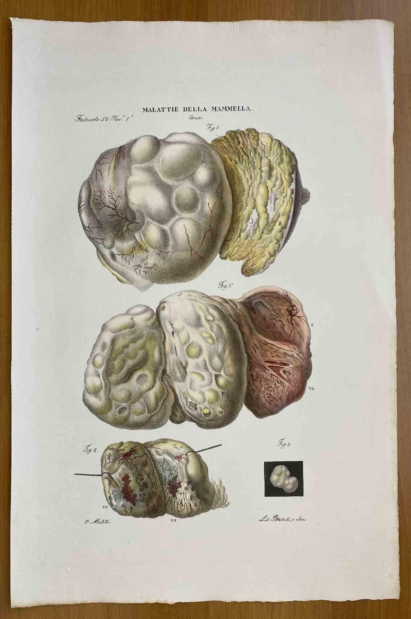 Breast Diseases is a lithograph hand colored by Ottavio Muzzi for the edition of Antoine Chazal, Human Anatomy, Printers Batelli and Ridolfi, 1843.

The work belongs to the Atlante generale della anatomia patologica del corpo umano by Jean