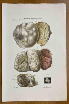 Breast Diseases - Lithograph By Ottavio Muzzi - 1843