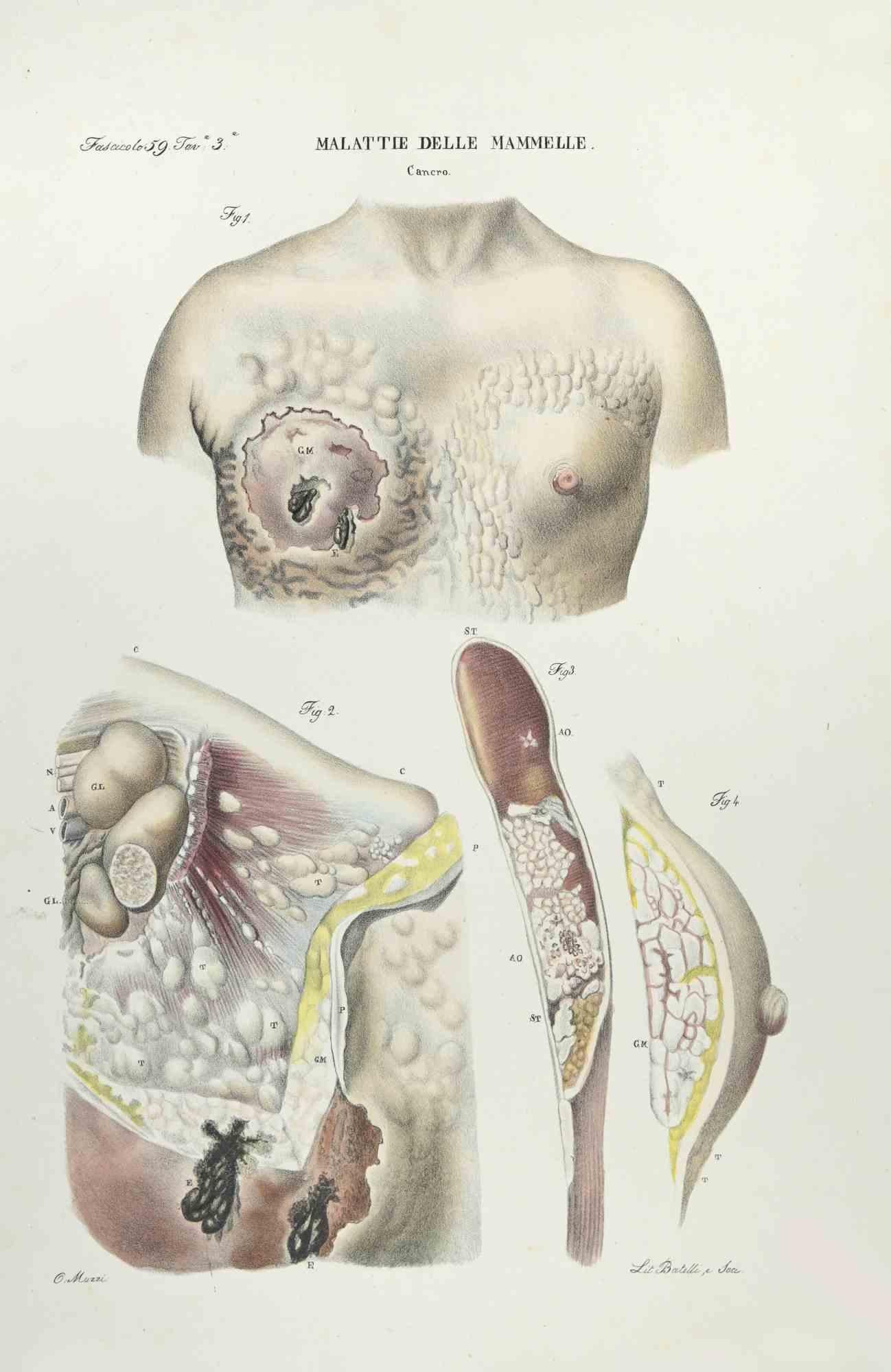 Breast Diseases is a lithograph hand colored by Ottavio Muzzi for the edition of Antoine Chazal,Human Anatomy, Printers Batelli and Ridolfi, realized in 1843.

Signed on plate on the lower left margin.

The artwork belongs to the "Atlante Generale