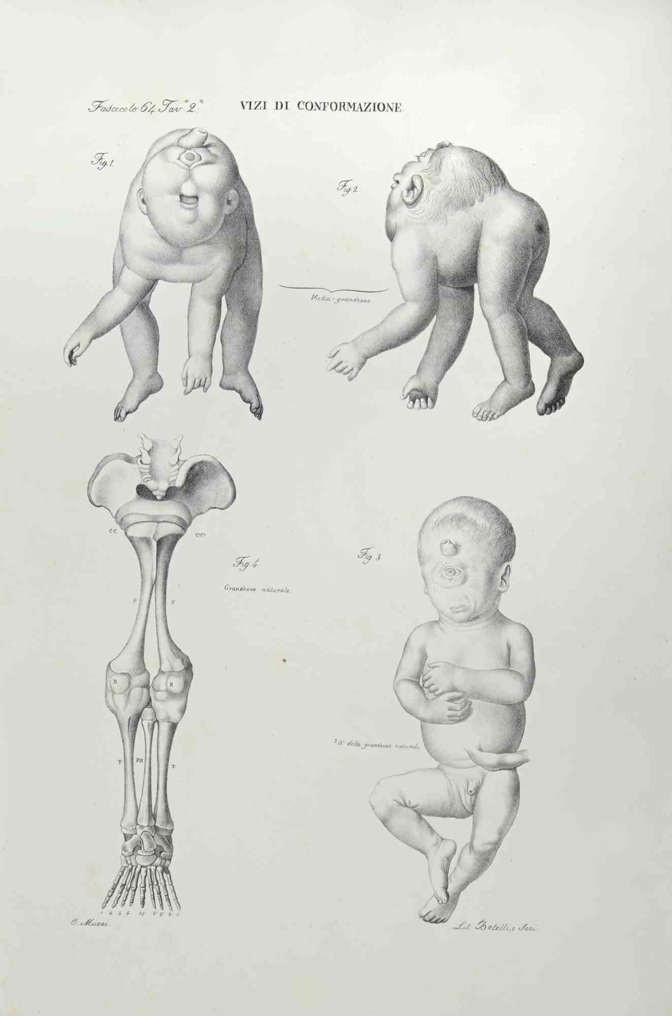 Conformation Defects is a  lithograph realized by Ottavio Muzzi for the edition of Antoine Chazal, Human Anatomy, Printers Batelli and Ridolfi, 1843.

The work belongs to the Atlante generale della anatomia patologica del corpo umano by Jean