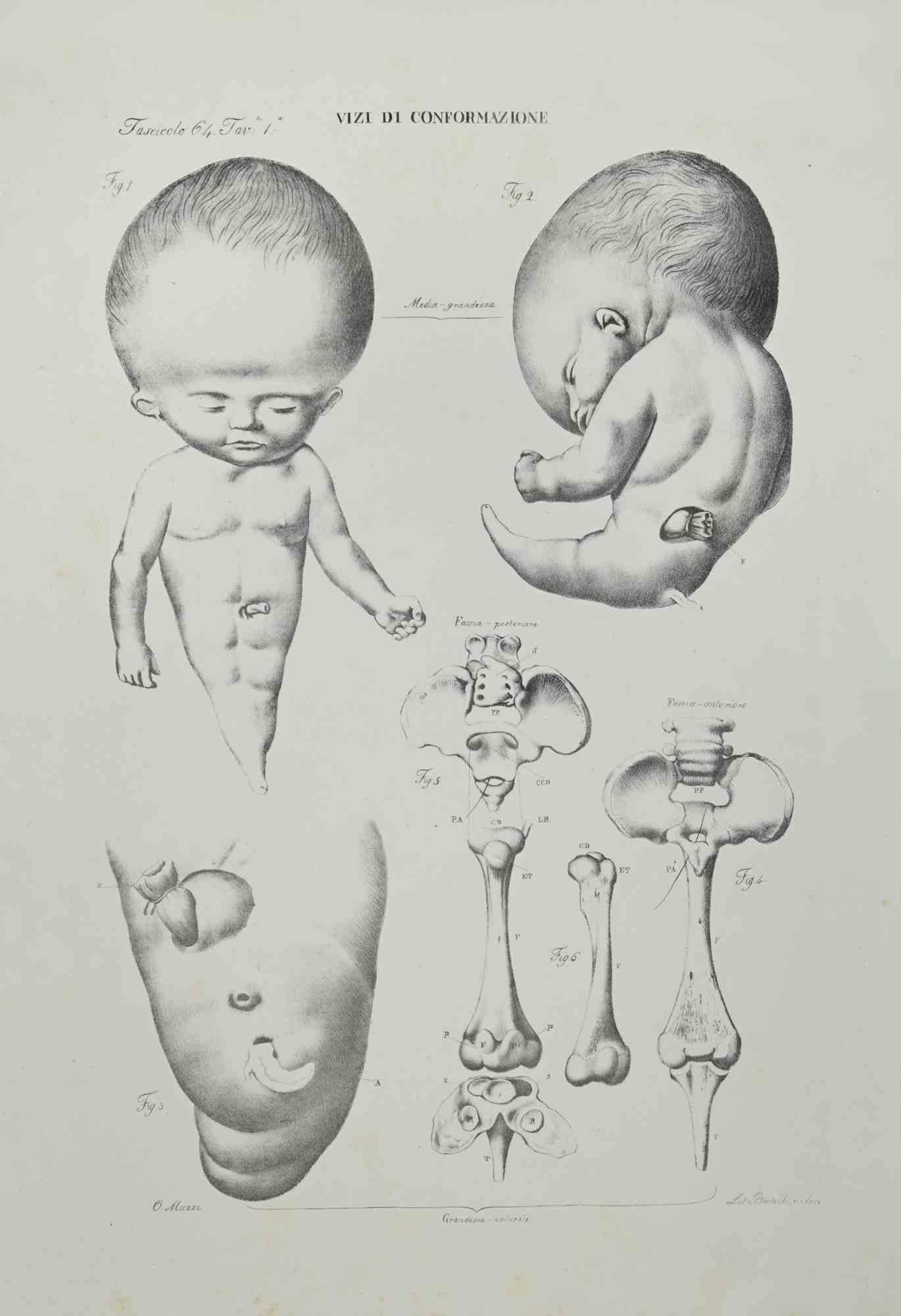 Conformation Defects is a lithograph realized by Ottavio Muzzi for the edition of Antoine Chazal, Human Anatomy, Printers Batelli and Ridolfi, 1843.

The work belongs to the Atlante generale della anatomia patologica del corpo umano by Jean