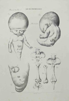 Défauts de conformation - Lithographie d'Ottavio Muzzi - 1843