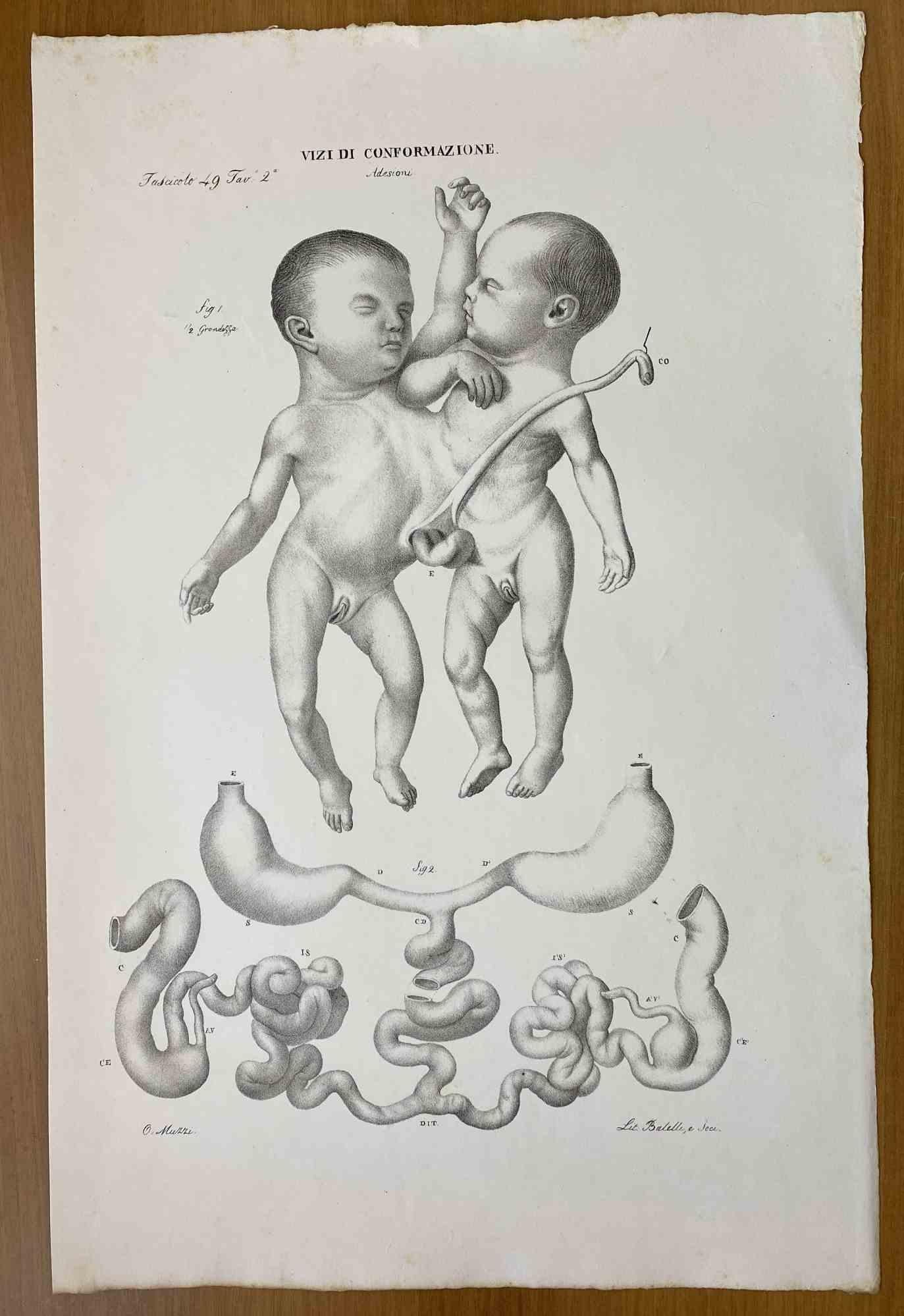 Conformation Defects is a lithograph hand colored by Ottavio Muzzi for the edition of Antoine Chazal, Human Anatomy, Printers Batelli and Ridolfi, 1843.

The work belongs to the Atlante generale della anatomia patologica del corpo umano by Jean