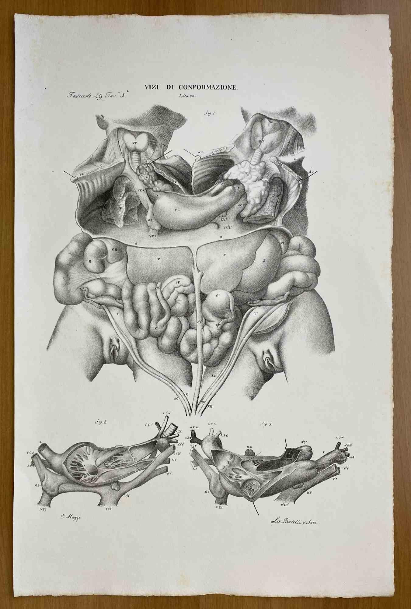 Conformation Defects is a lithograph hand colored by Ottavio Muzzi for the edition of Antoine Chazal, Human Anatomy, Printers Batelli and Ridolfi, 1843.

The work belongs to the Atlante generale della anatomia patologica del corpo umano by Jean