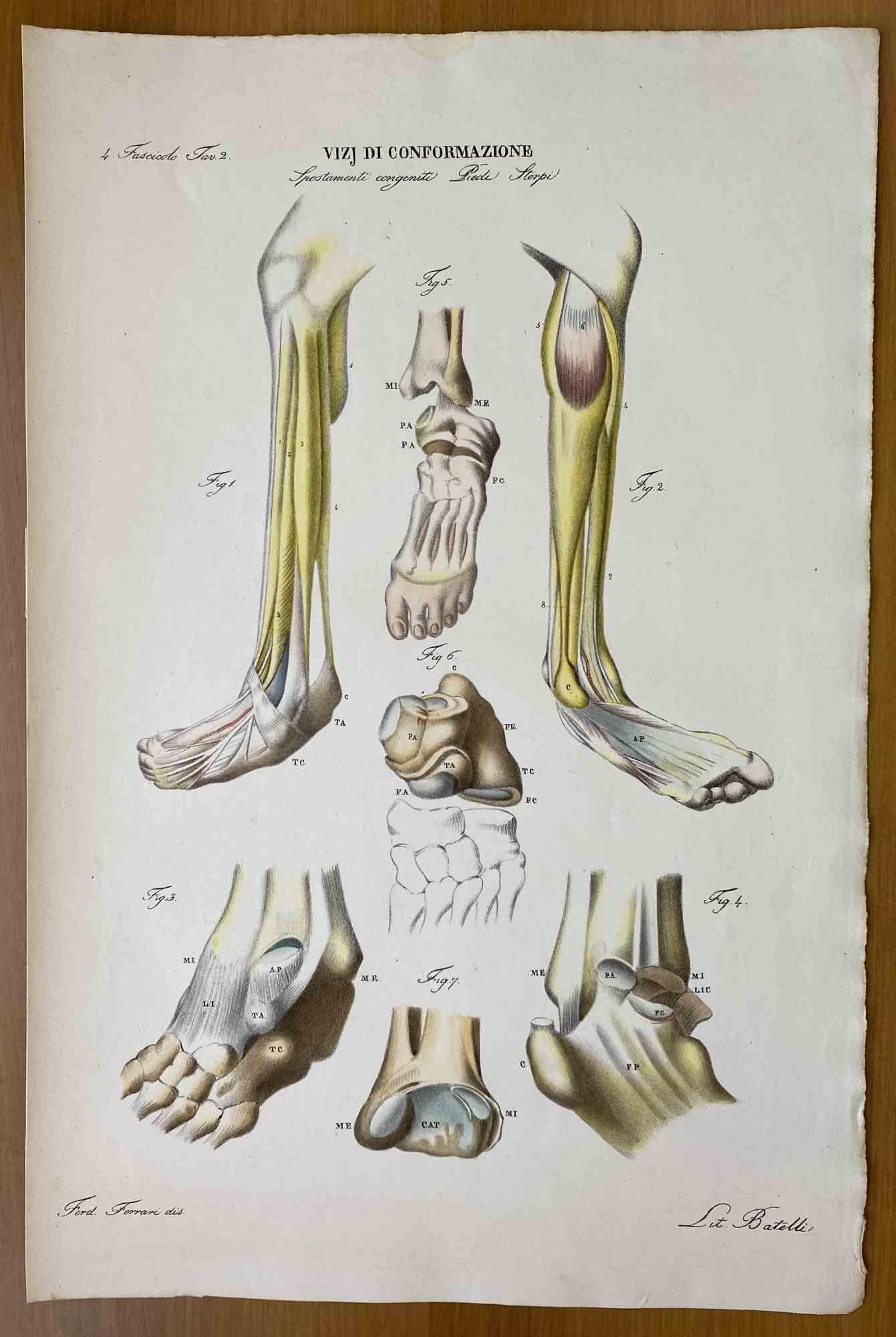 Conformation Defects is a lithograph hand colored by Ottavio Muzzi for the edition of Antoine Chazal, Human Anatomy, Printers Batelli and Ridolfi, 1843.

The work belongs to the Atlante generale della anatomia patologica del corpo umano by Jean
