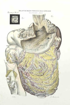 Deseaes of the Stomach of  Epiploon - Lithograph By Ottavio Muzzi - 1843