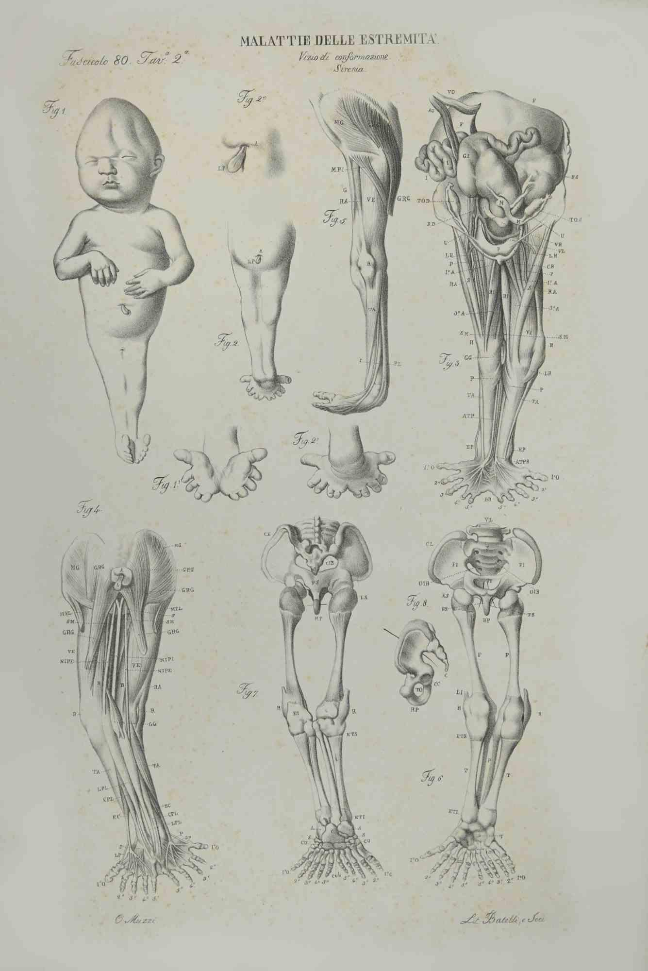 Diseases of Extremities is a lithograph hand colored by Ottavio Muzzi for the edition of Antoine Chazal, Human Anatomy, Printers Batelli and Ridolfi, 1843.

The work belongs to the Atlante generale della anatomia patologica del corpo umano by Jean