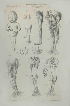 Les maladies des extrêmes - Lithographie d'Ottavio Muzzi - 1843