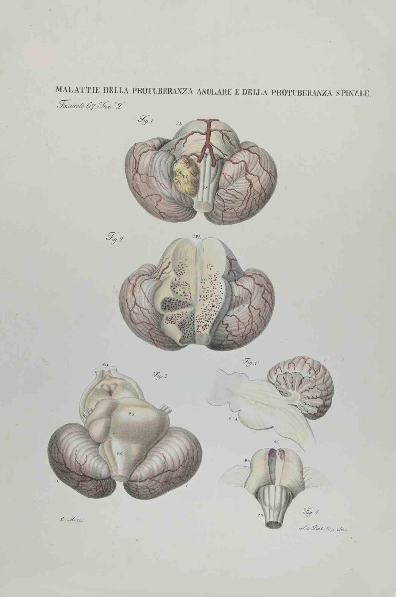 Ottavio Muzzi Figurative Print - Diseases of the Annular Protuberance and Spinal Protuberance-Lithograph-1843