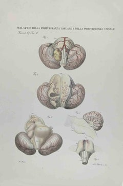 Krankheiten des Jahres Protuberance- und Spinal Protuberance-Lithographie-1843
