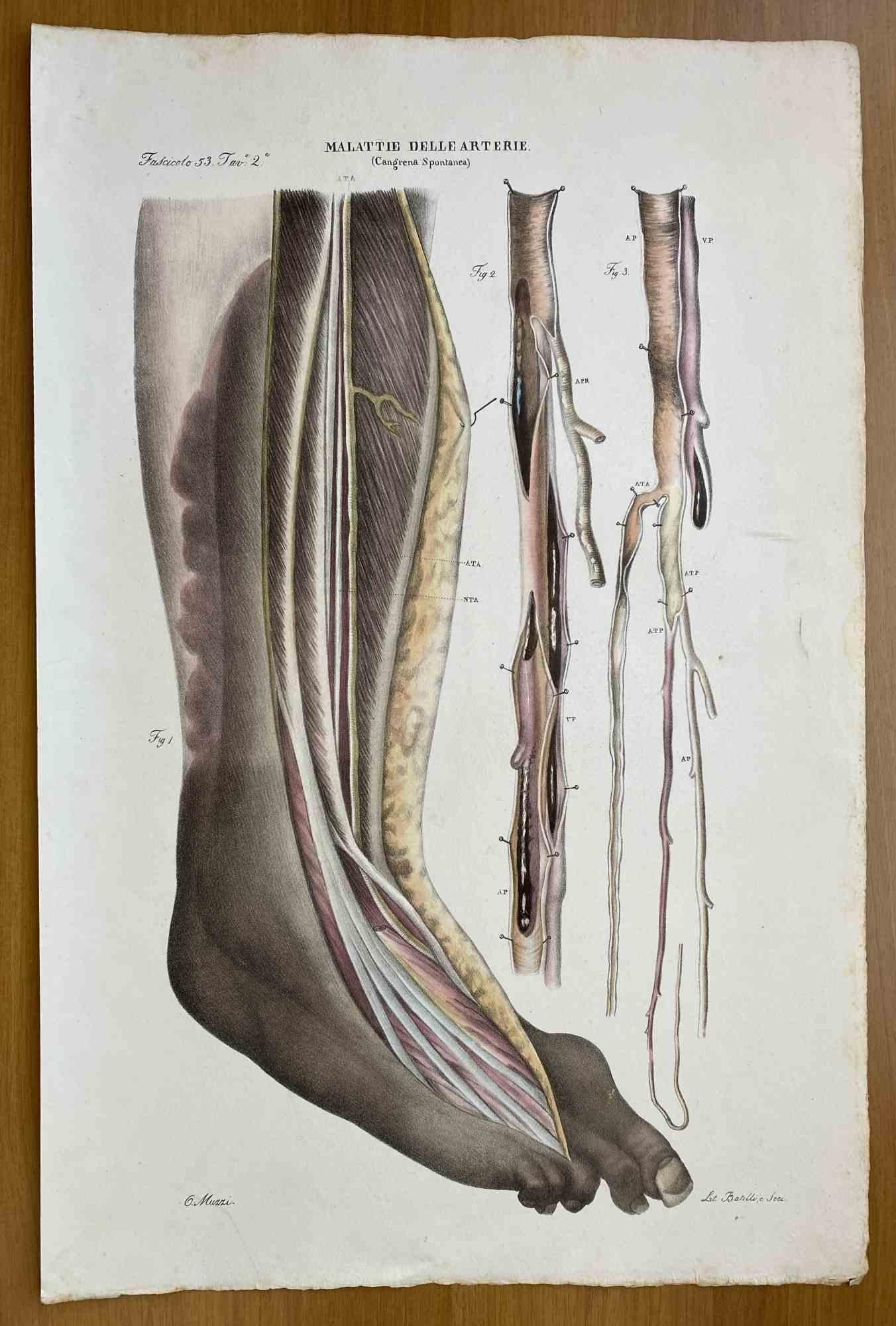 Diseases of the Arteries is a lithograph hand colored by Ottavio Muzzi for the edition of Antoine Chazal, Human Anatomy, Printers Batelli and Ridolfi, 1843.

The work belongs to the Atlante generale della anatomia patologica del corpo umano by Jean