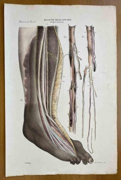 Diseases of the Arteries - Lithograph By Ottavio Muzzi - 1843
