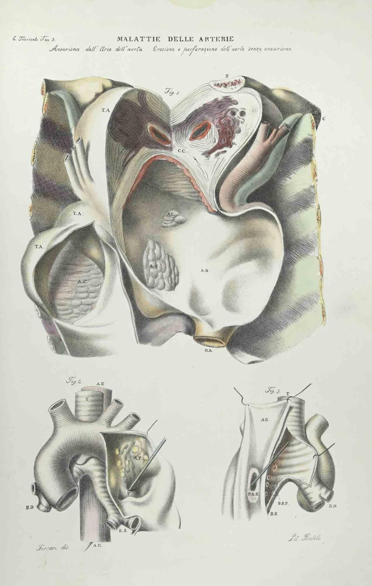 Krankheiten der Künste – Lithographie von Ottavio Muzzi – 1843