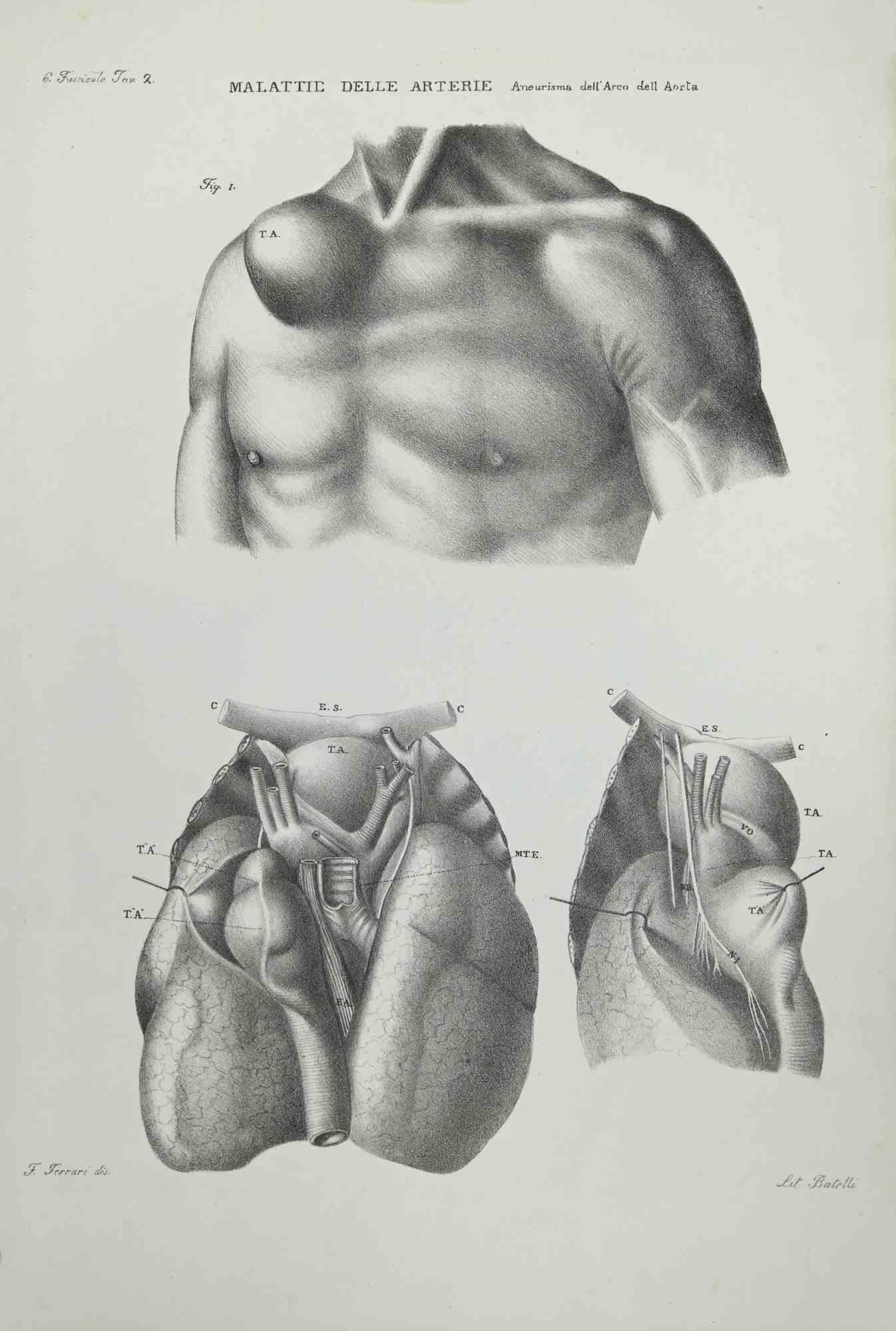 Krankheiten der Künste – Lithographie von Ottavio Muzzi – 1843