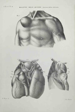 Diseases of the Arteries - Lithograph By Ottavio Muzzi - 1843