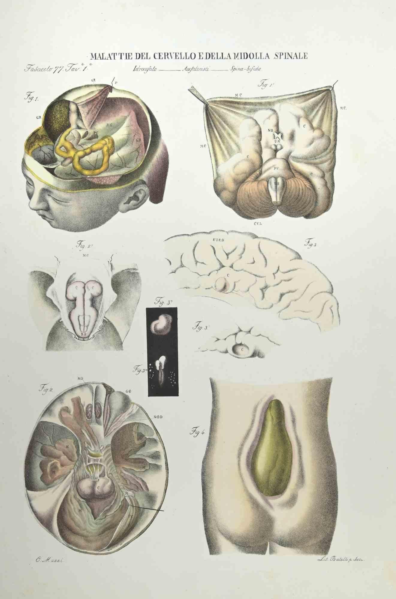 Diseases of the Brain and Spinal Cord  is a lithograph hand colored by Ottavio Muzzi for the edition of Antoine Chazal,Human Anatomy, Printers Batelli and Ridolfi, realized in 1843.

Signed on plate on the lower left margin.

The artwork belongs to