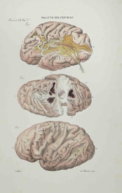 Diseases of the Brain - Lithograph By Ottavio Muzzi - 1843