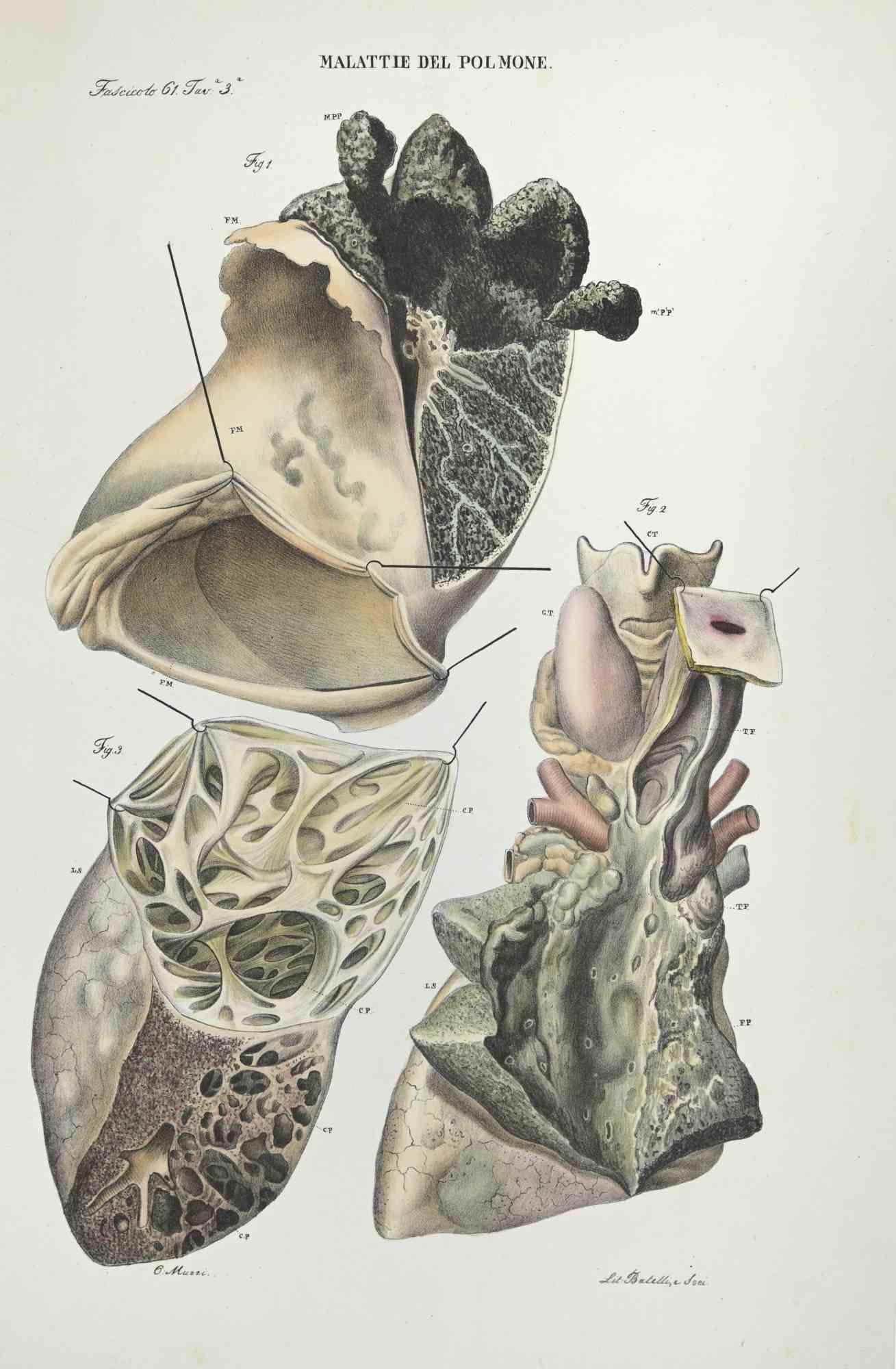 diseases of the Brain – Lithographie von Ottavio Muzzi – 1843