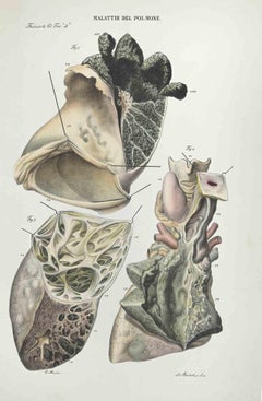 Malattie del cervello - Litografia di Ottavio Muzzi - 1843