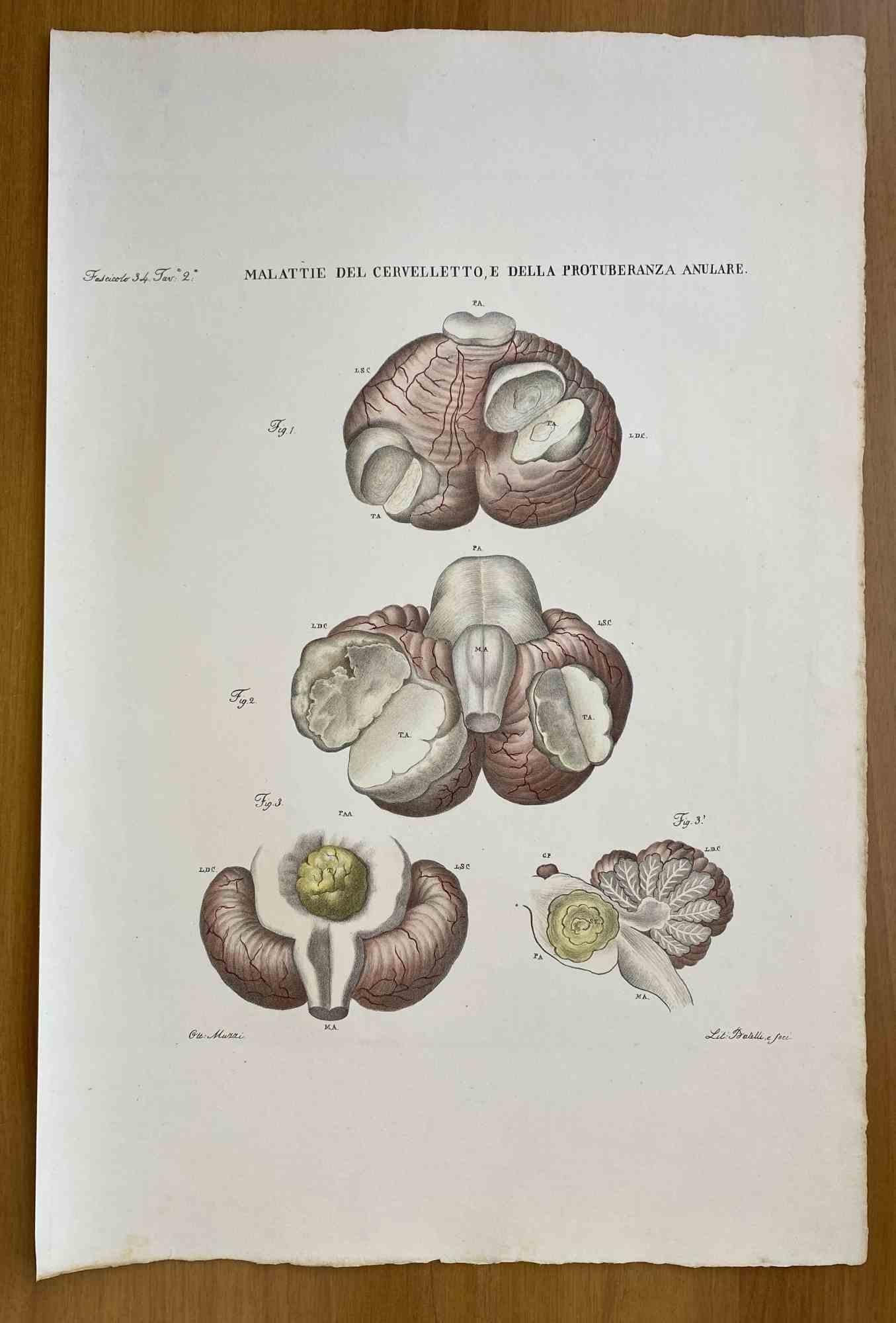 Diseases of the Cerebellum is a lithograph hand colored by Ottavio Muzzi for the edition of Antoine Chazal, Human Anatomy, Printers Batelli and Ridolfi, 1843.

The work belongs to the Atlante generale della anatomia patologica del corpo umano by