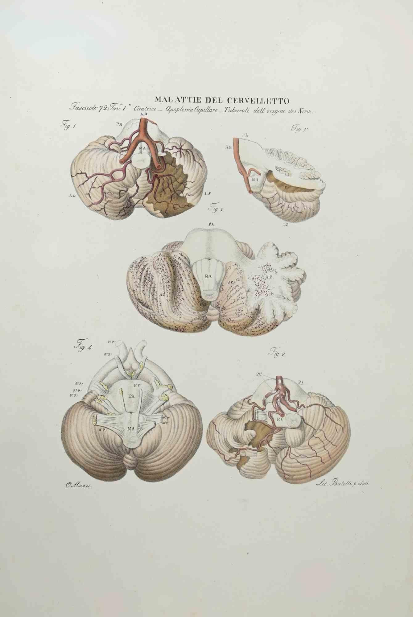 Maladies du cervelet est une lithographie coloriée à la main par Ottavio Muzzi pour l'édition d'Antoine Chazal, Anatomie humaine, Imprimeurs Batelli et Ridolfi, réalisée en 1843.

Signé sur la plaque dans la marge inférieure gauche.

L'œuvre