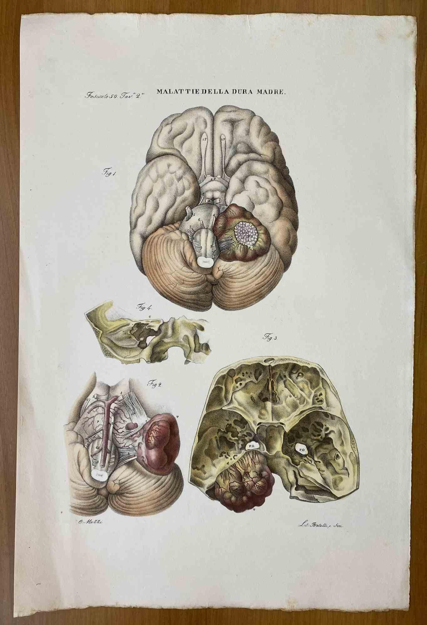 Diseases of the Dura Mater - Lithograph By Ottavio Muzzi - 1843