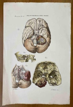 Krankheiten der Dura Mater – Lithographie von Ottavio Muzzi – 1843