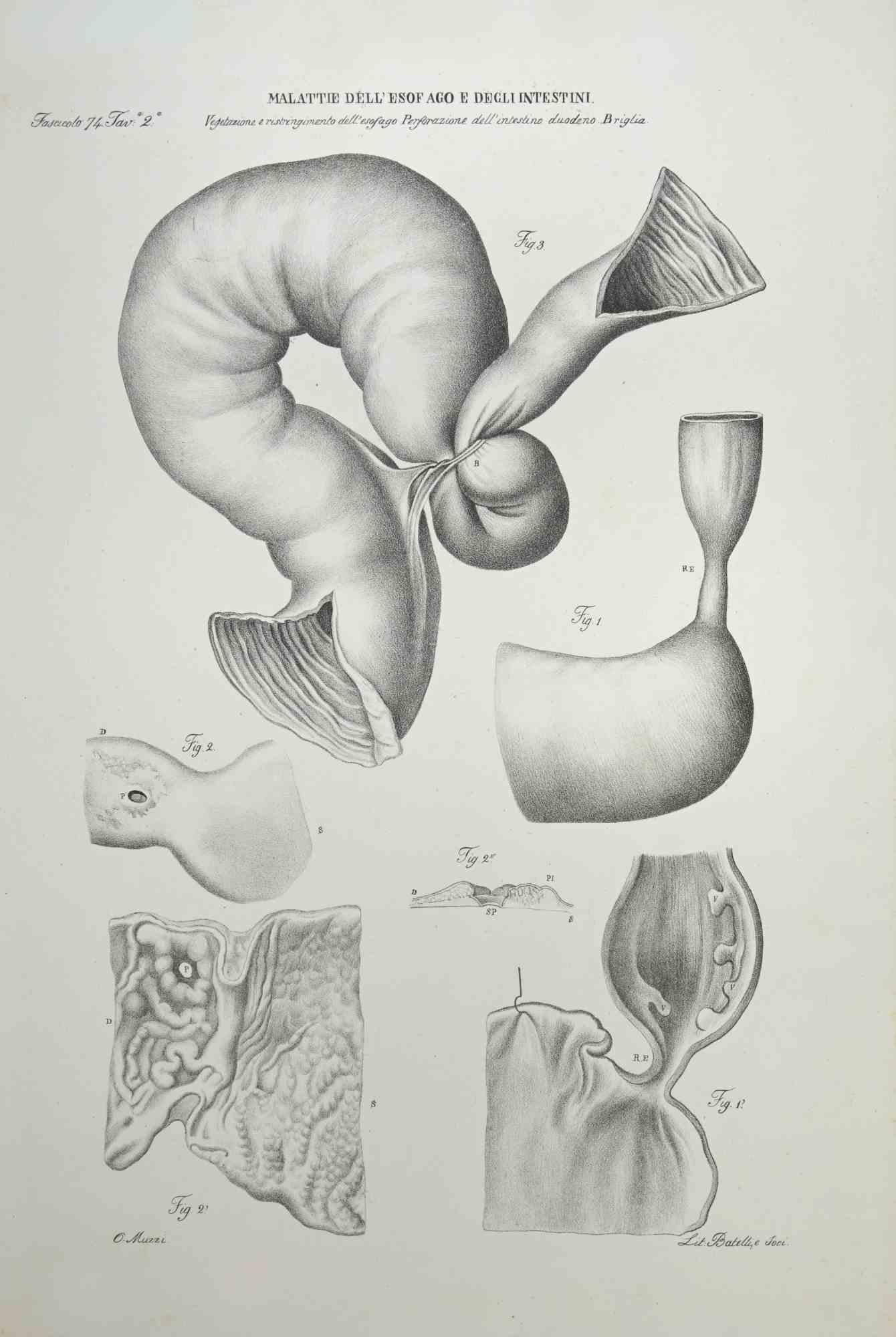 Malattie dell'Esofago e dell'Intestino è una litografia colorata a mano da Ottavio Muzzi per l'edizione di Antoine Chazal, Anatomia Umana, tipografia Batelli e Ridolfi, realizzata nel 1843.

Firmato sulla lastra nel margine inferiore