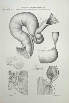 Diseases of the Esophagus and Intestines - Lithograph By Ottavio Muzzi - 1843