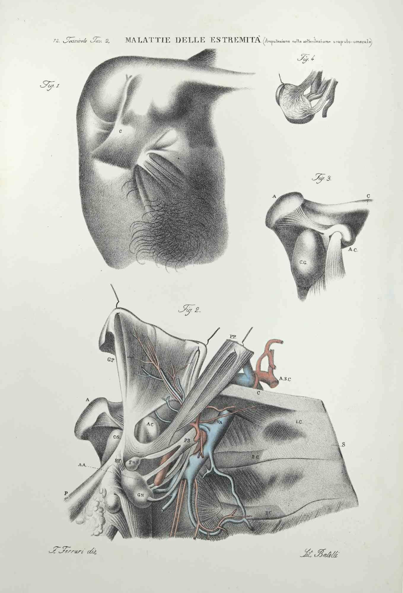 diseases of the Extremities – Lithographie von Ottavio Muzzi – 1843