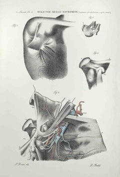 Diseases of the Extremities - Lithograph By Ottavio Muzzi - 1843
