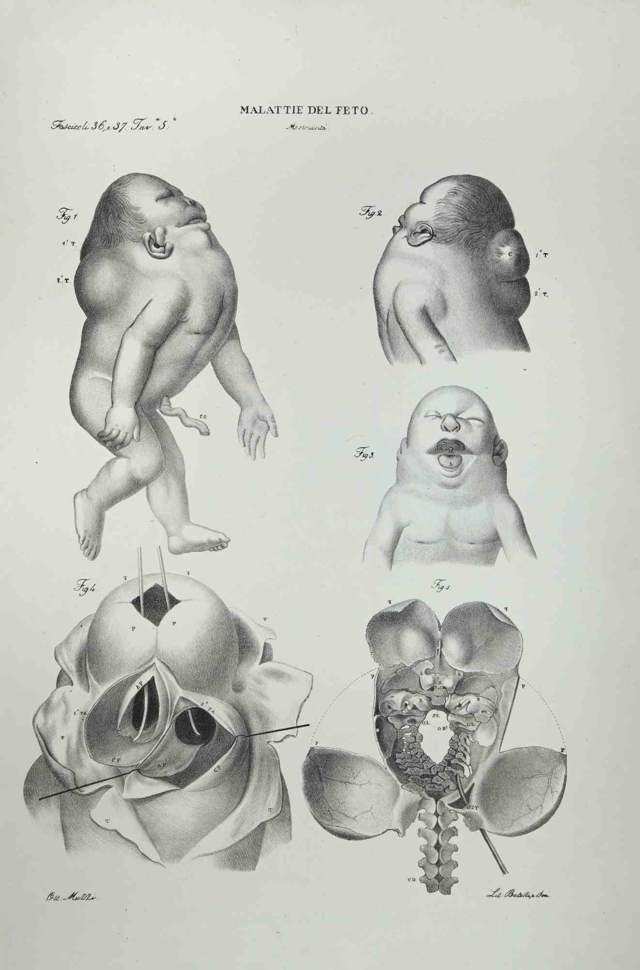 Diseases of the Fetus is a lithograph hand colored by Ottavio Muzzi for the edition of Antoine Chazal,Human Anatomy, Printers Batelli and Ridolfi, realized in 1843.

Signed on plate on the lower left margin.