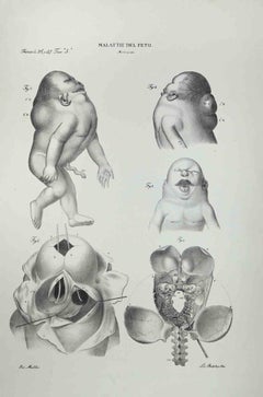 Krankheiten des Fetus – Lithographie von Ottavio Muzzi – 1843