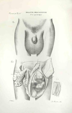 Diseases of the Intestines - Lithograph By Ottavio Muzzi - 1843